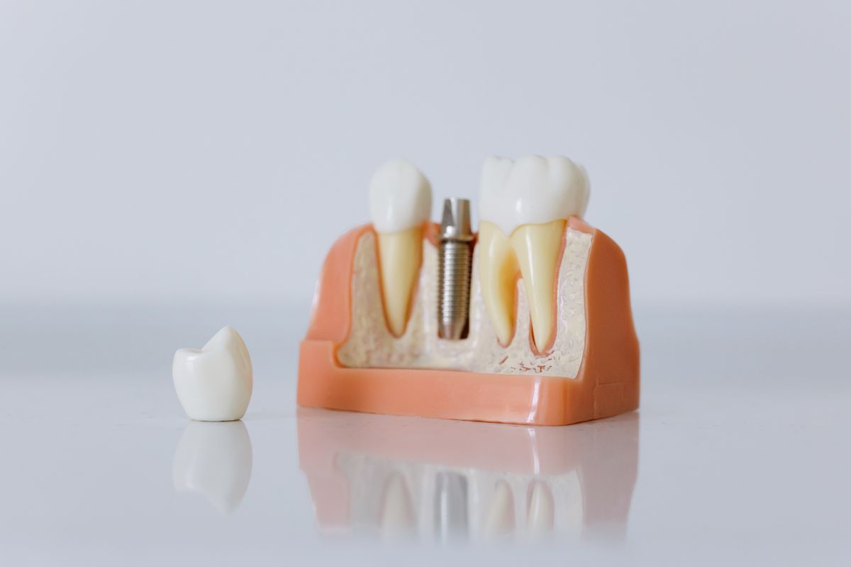3D model showing four implants supporting a full dental arch