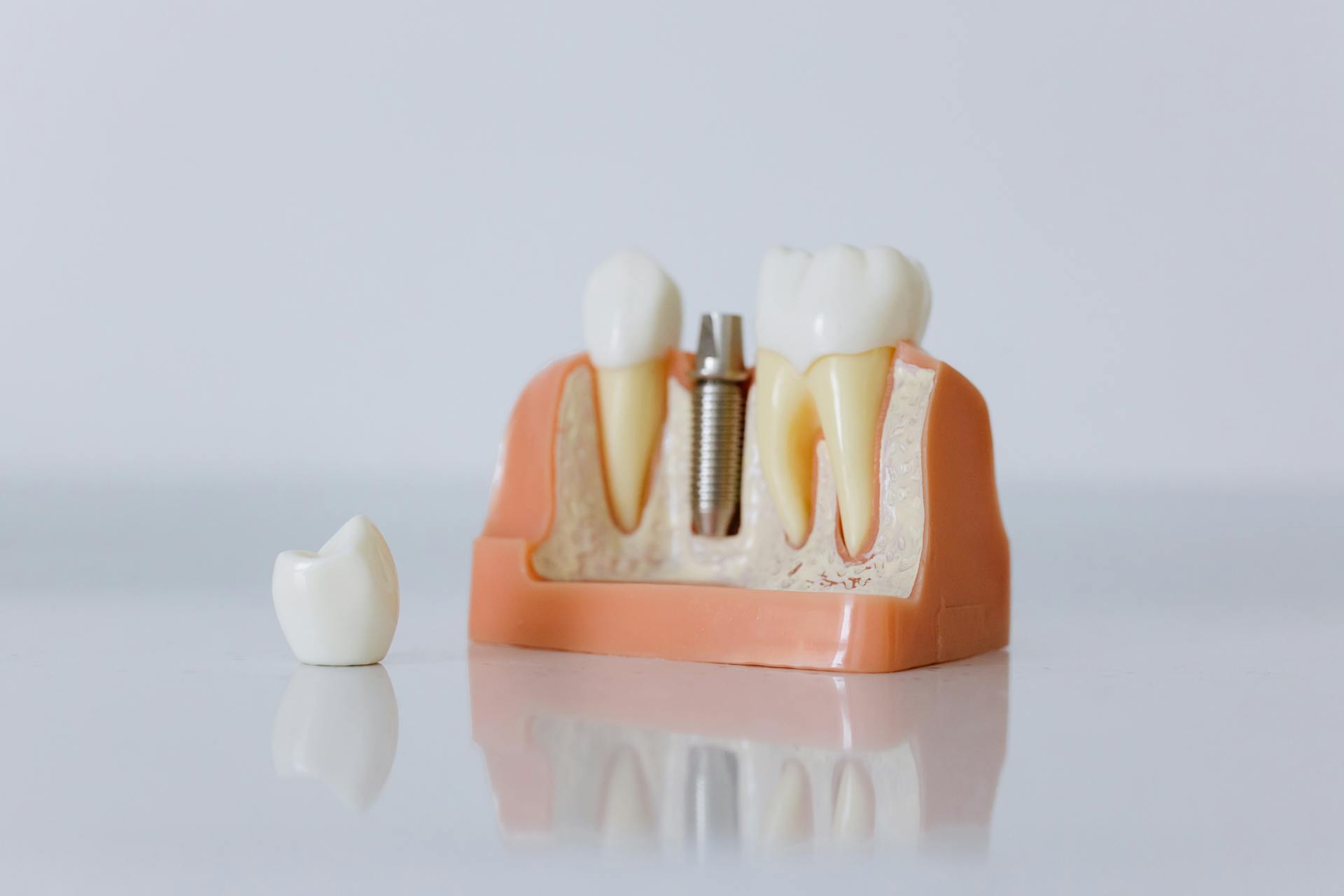 Close-Up Shot of Dental Implant Model