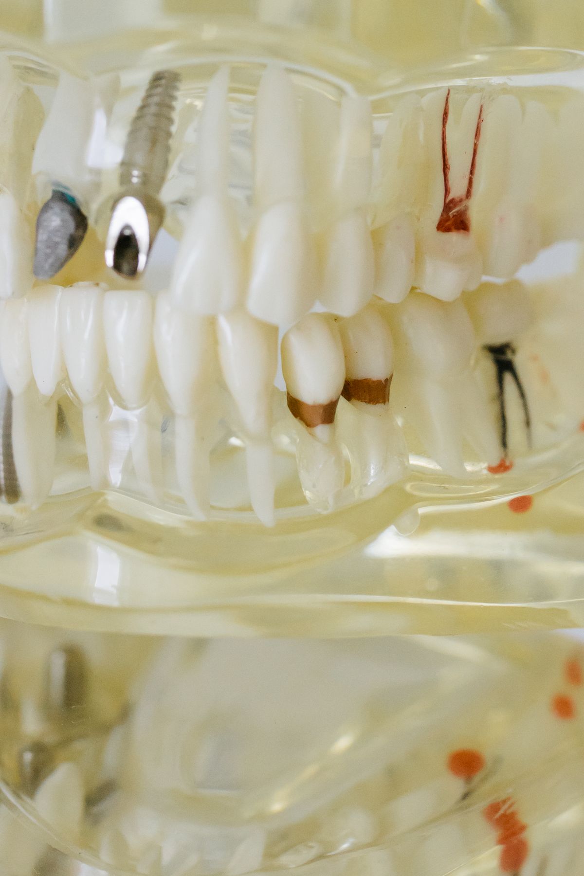 Close-up dental model used to explain gum disease and periodontal treatment