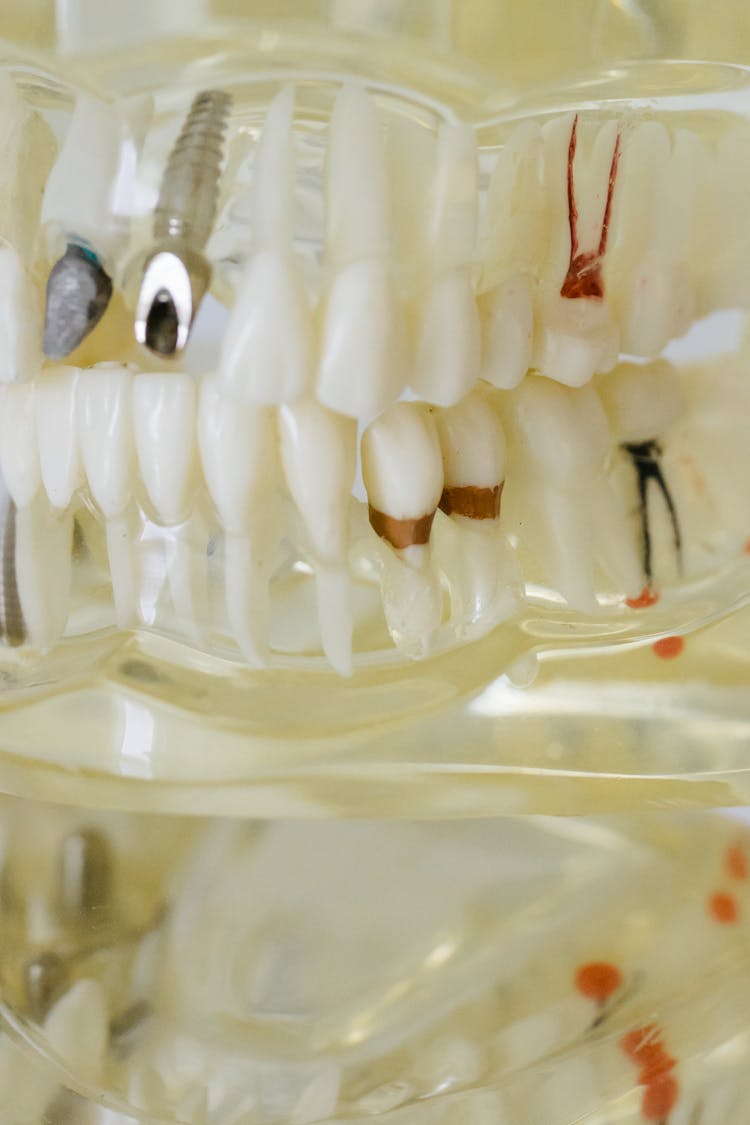 Disease Dental Teeth Model In Close Up Photography