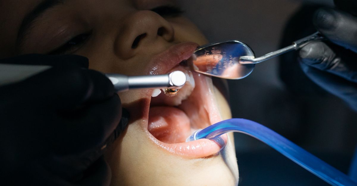 What to Expect with Silver Diamine Fluoride: A Needle-Free Solution for Treating Early Cavities in Young Kids