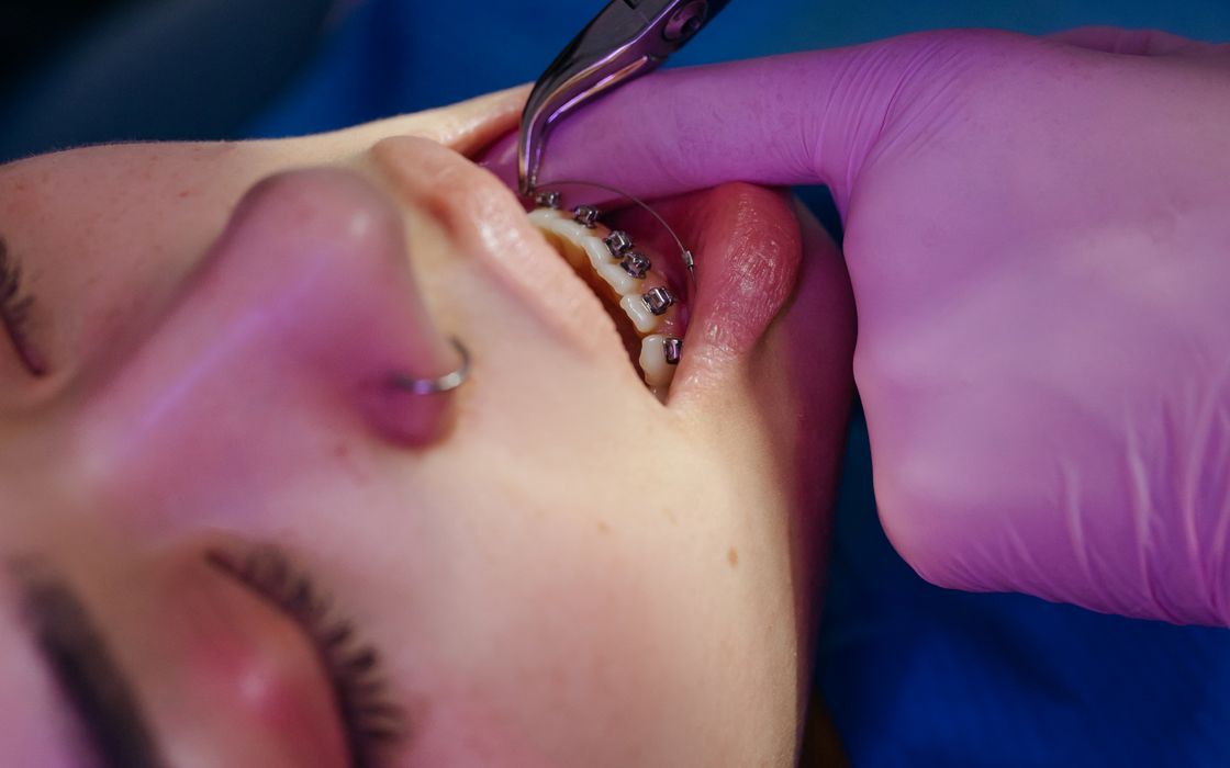 A close-up view of a dental procedure involving braces on a teen.