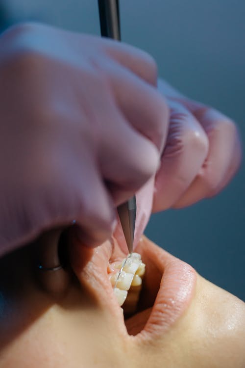 Close-up Photo of Dentist Examining Patient's Teeth