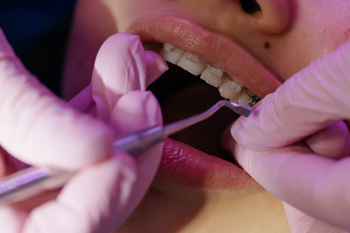 Free Treating of a Teeth with Braces Stock Photo