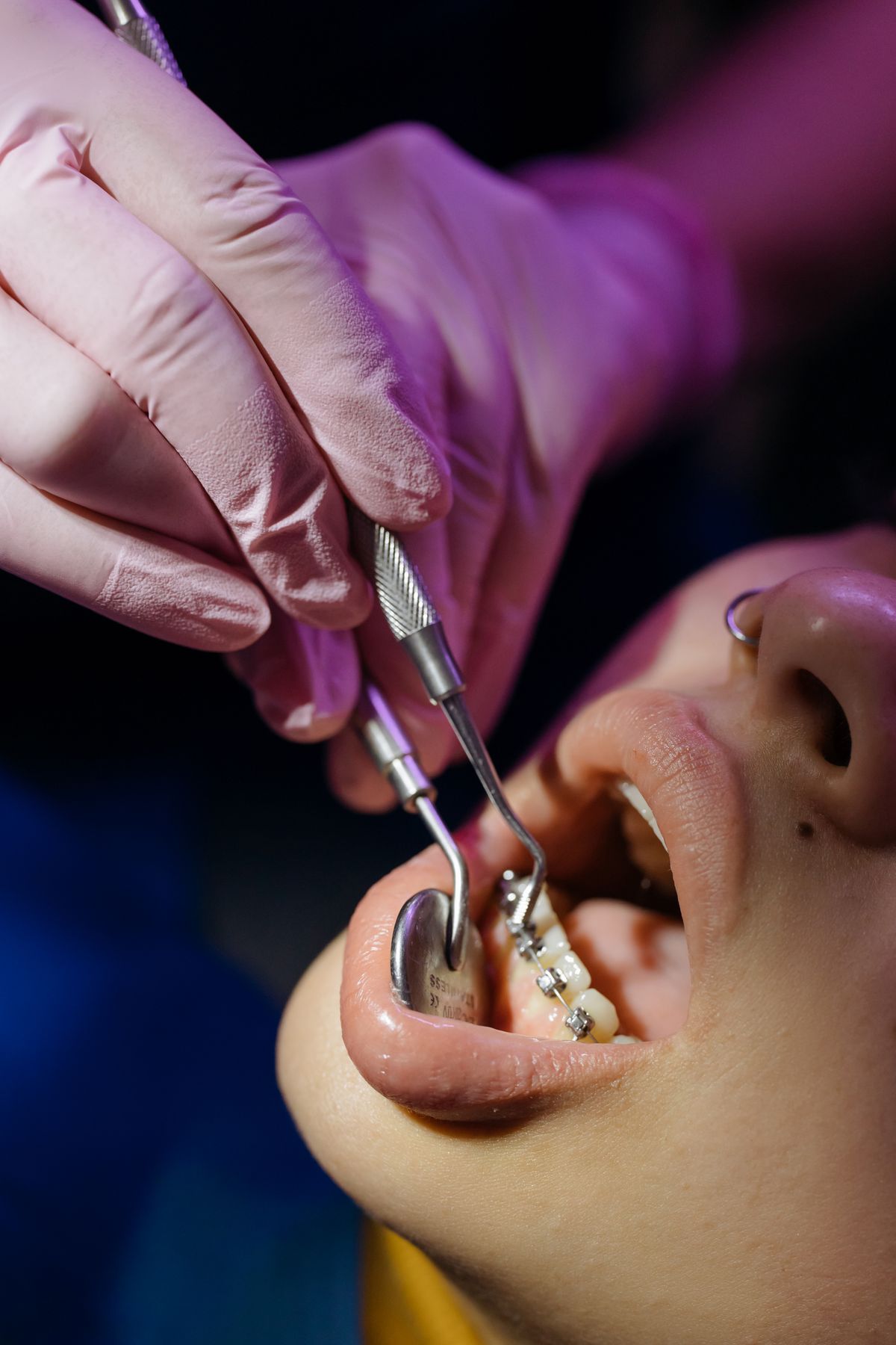 Close-up of an orthodontic braces adjustment during a dental checkup