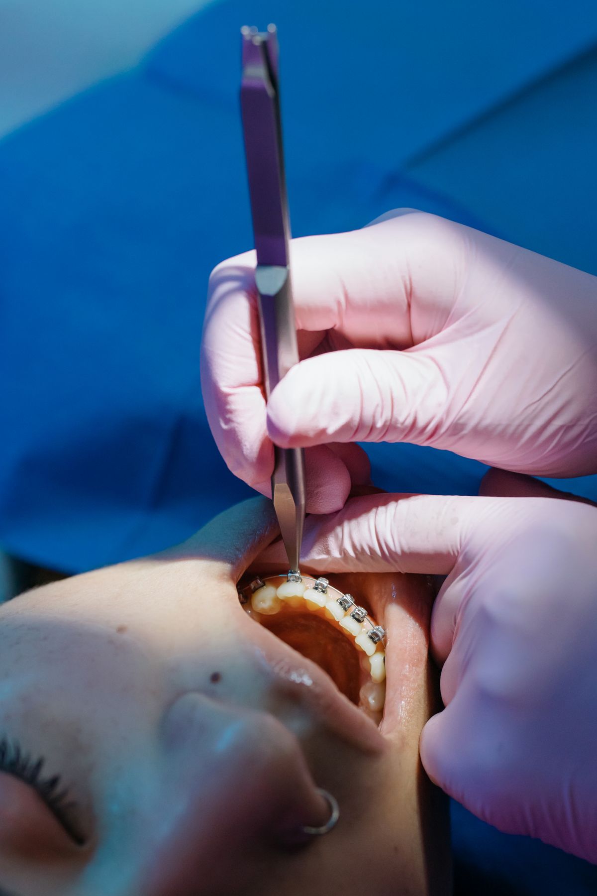 Single Sitting Root Canal Treatment