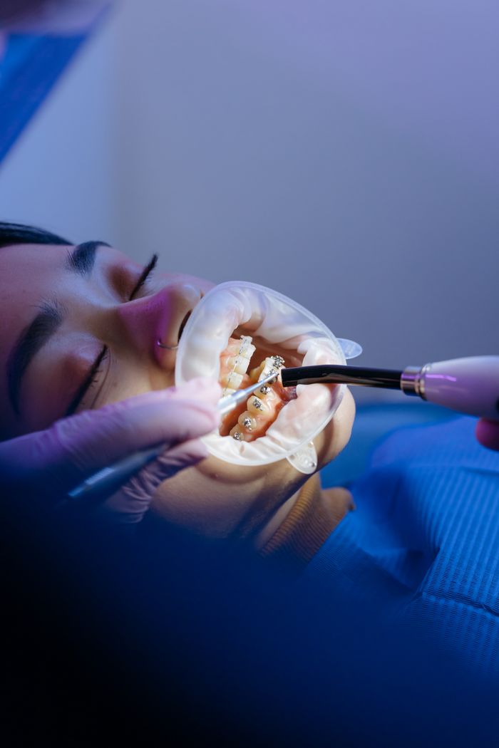 Illustration du résultat — orthodontie