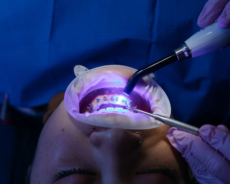 A dentist using a blue curing light to harden a tooth-coloured filling