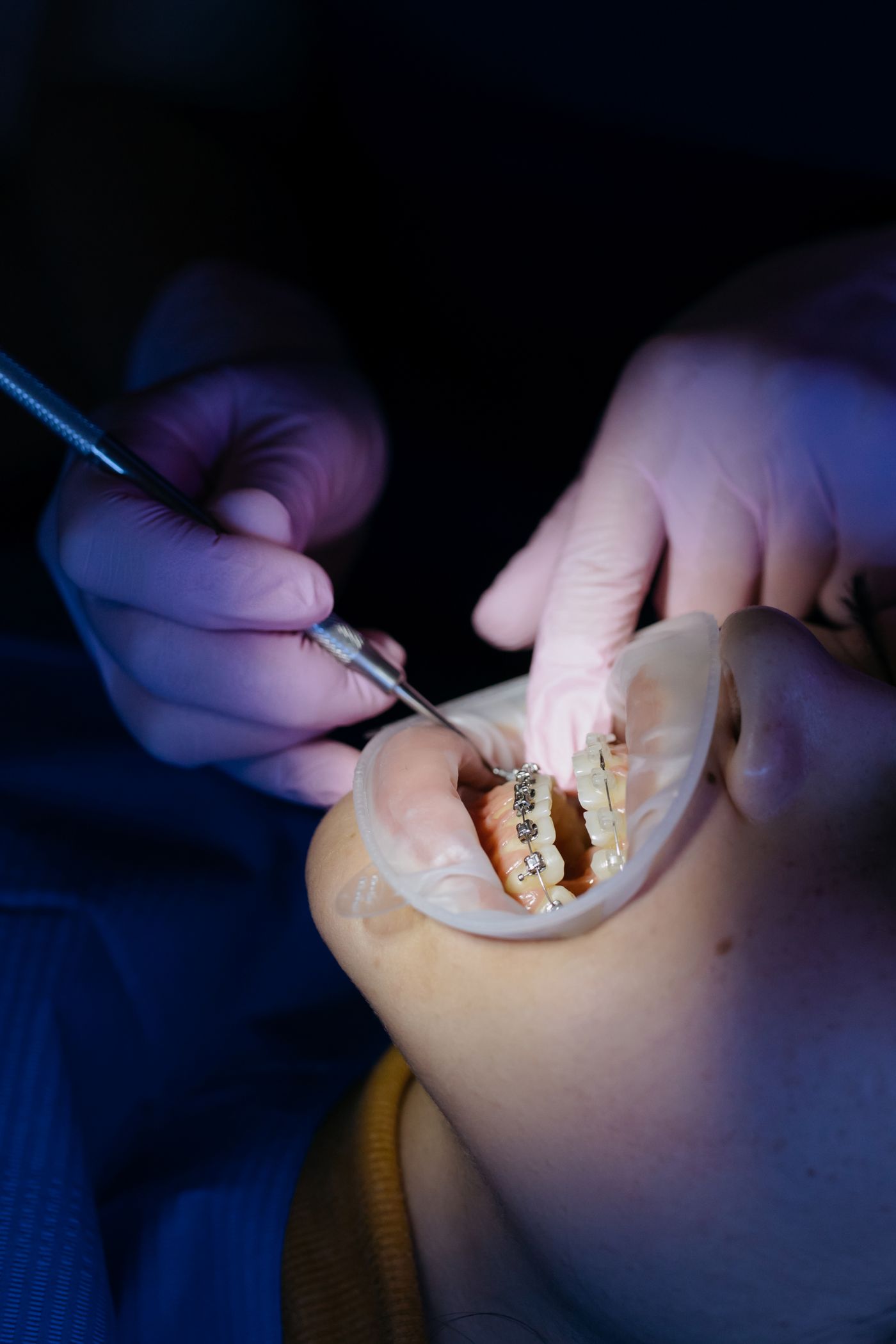 Close clinical view of a composite dental restoration