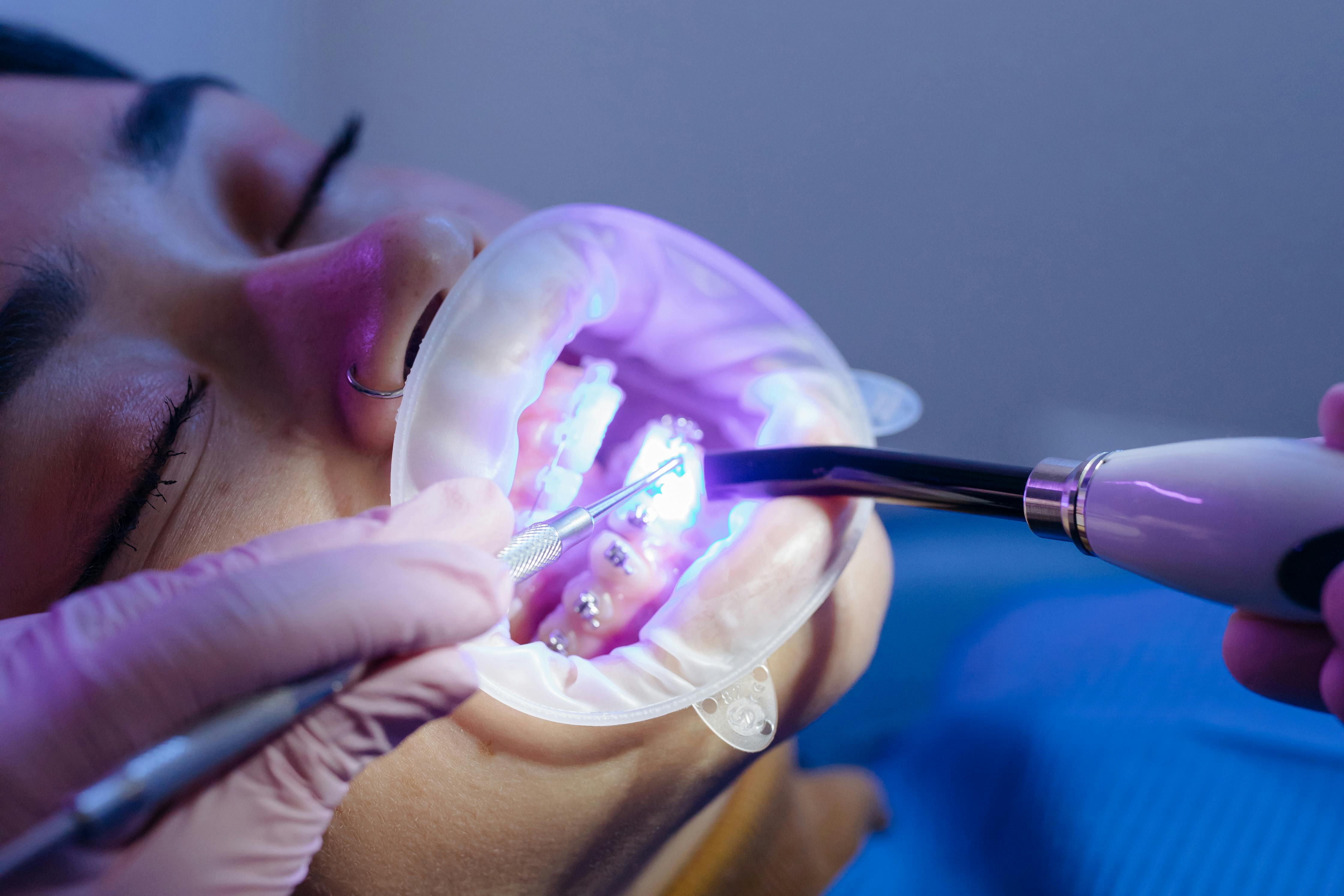 Orthodontist Applying Uv Light Cure Orthodontic Stock Footage