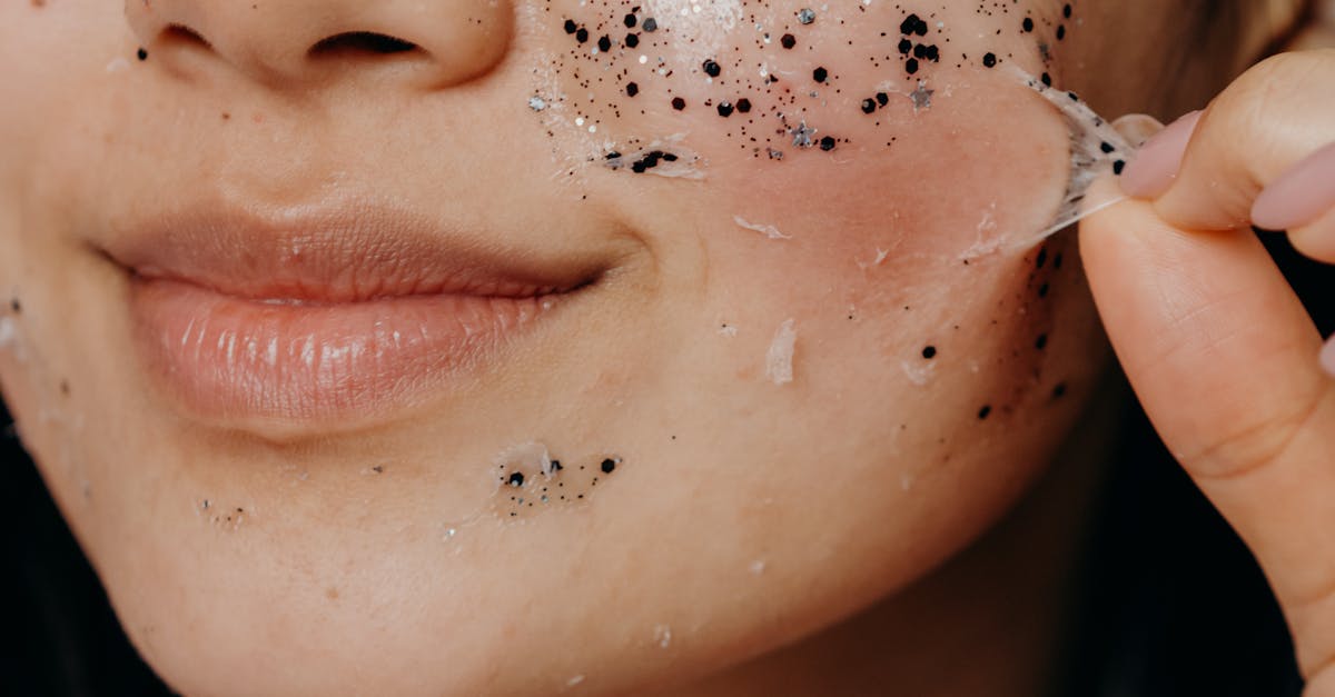 How to get rid of peeling skin on face from sunburn fast