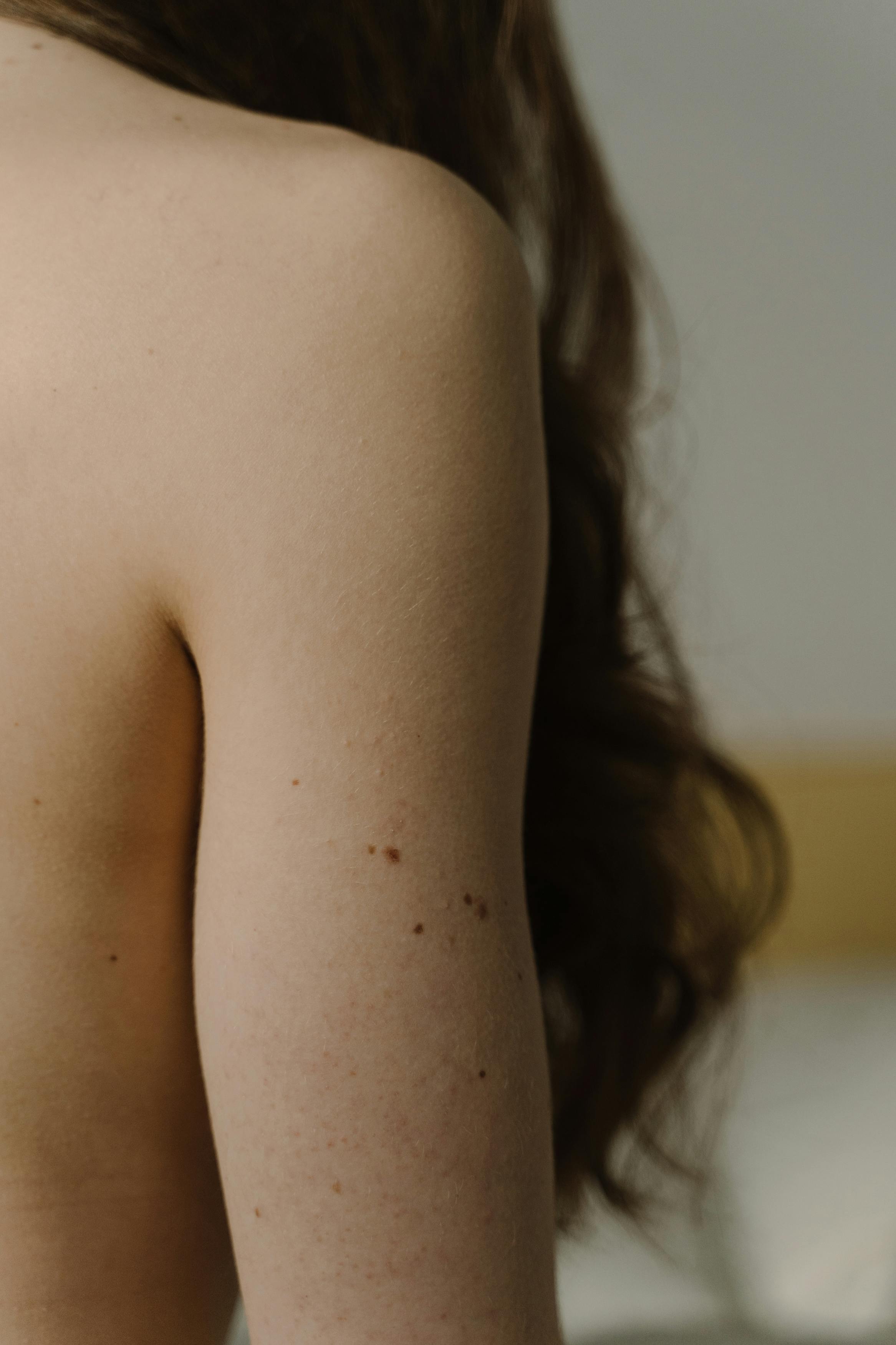 moles on a person s skin