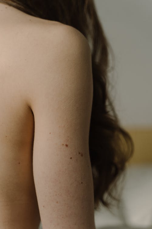 Free Moles on a Person's Skin Stock Photo