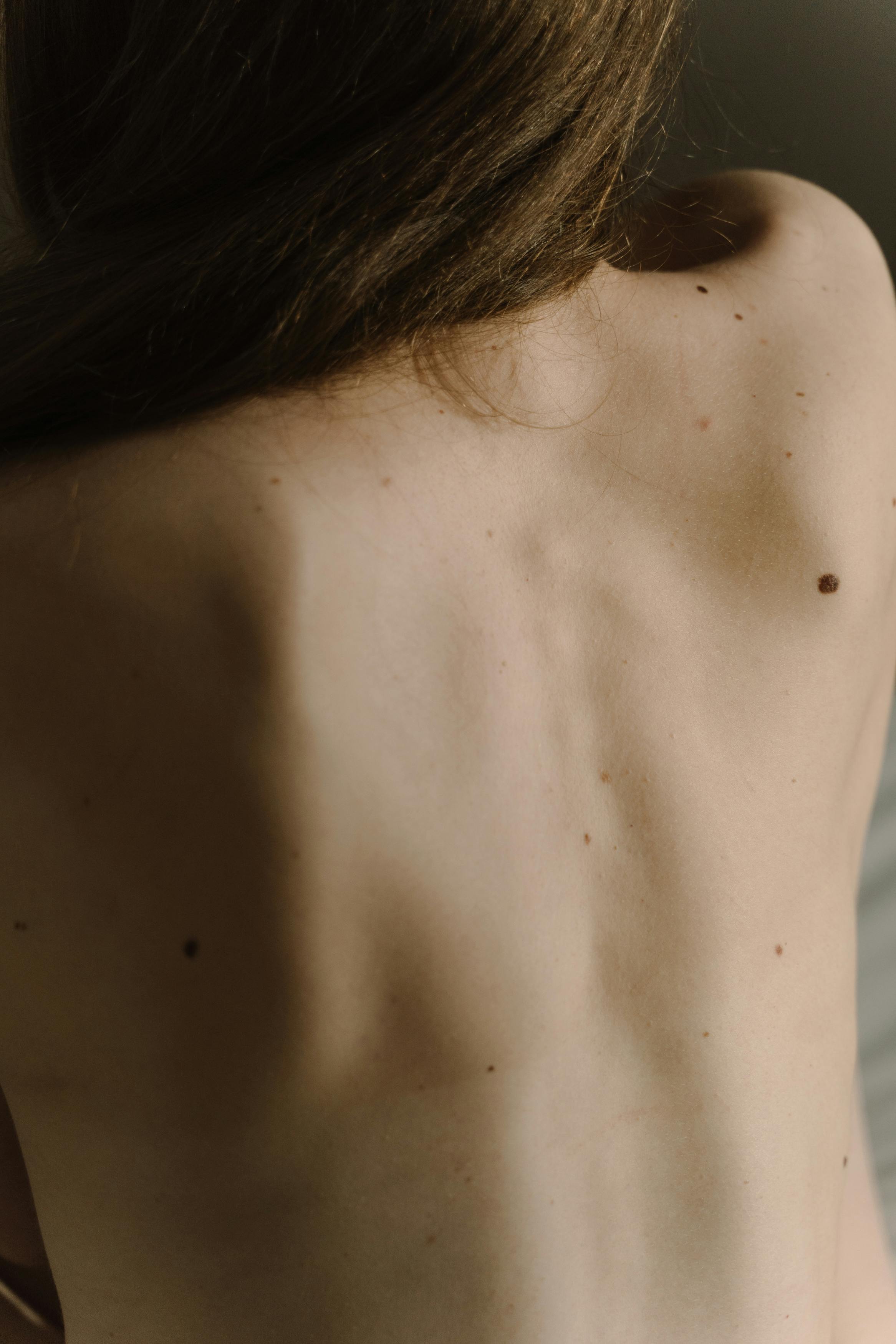 moles on a person s back