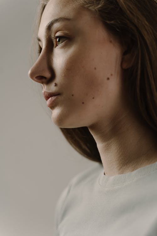 Moles on a Woman's Face