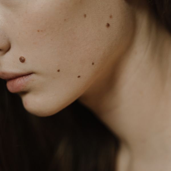Cheek with pigmentation before treatment