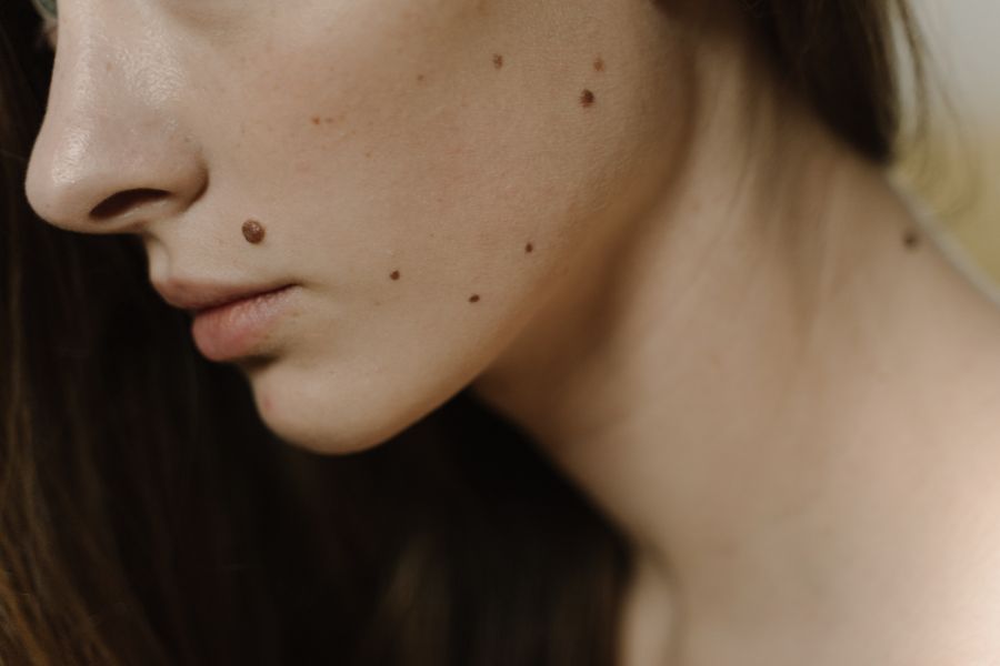 Cautery – Warts, Skin Tags & Moles