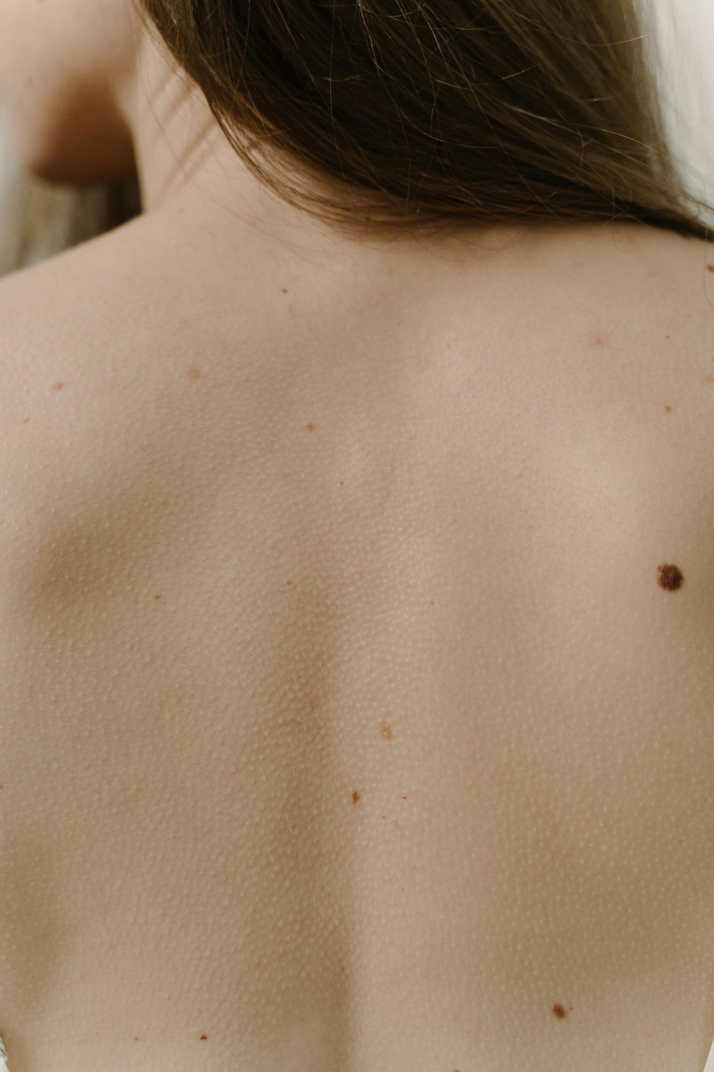 moles on woman shirtless back