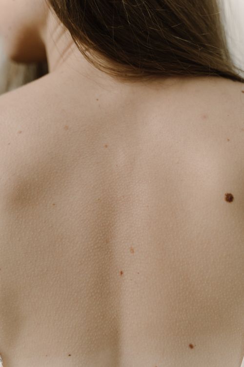 Free Detailed view of a woman's back with moles, emphasizing skin texture. Stock Photo