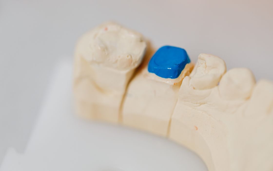 Close-up of a dental jaw model with a blue filling, showcasing dental anatomy and dentistry tools.