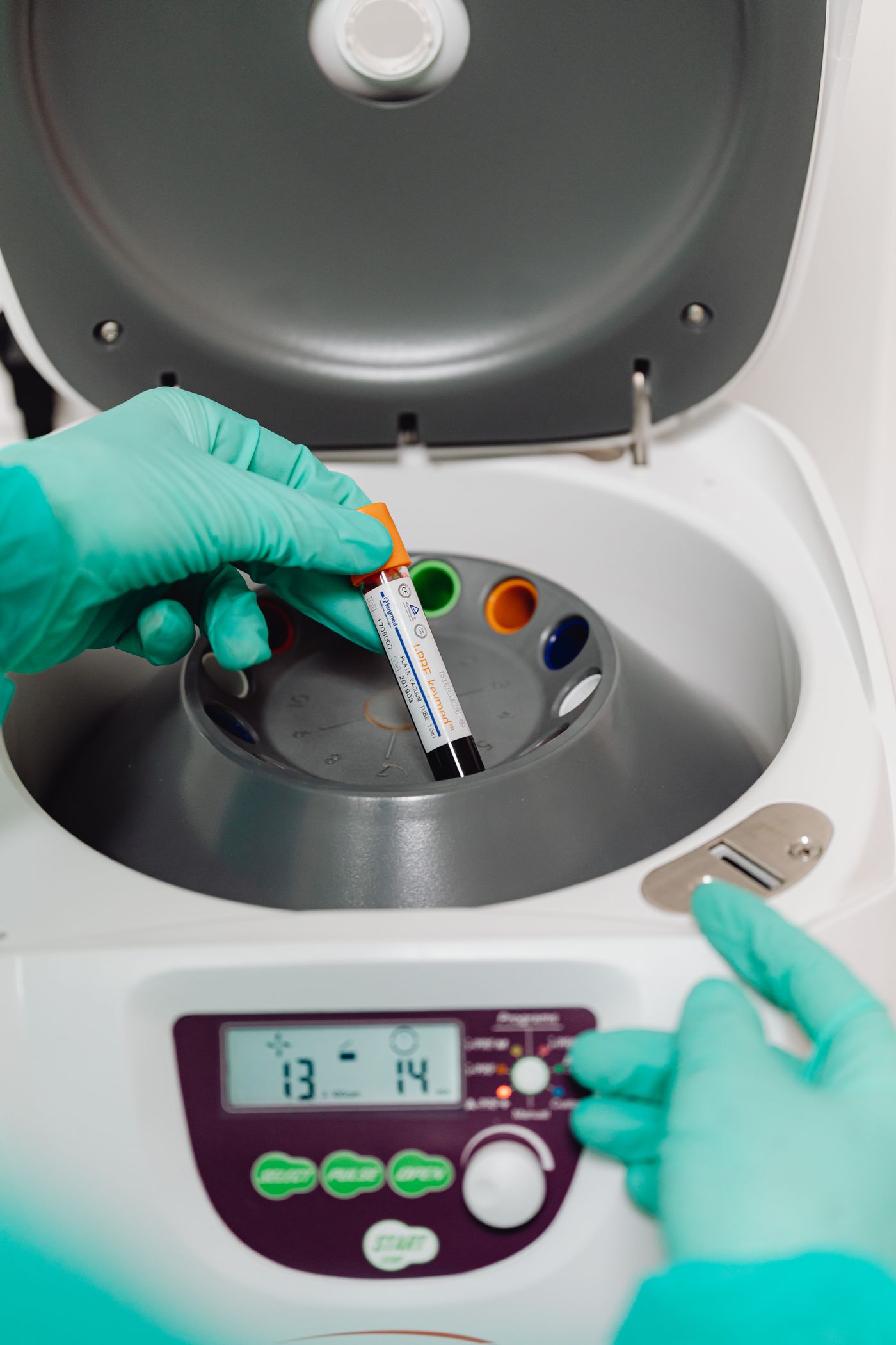 Blood sample being spun in a centrifuge to prepare platelet rich plasma