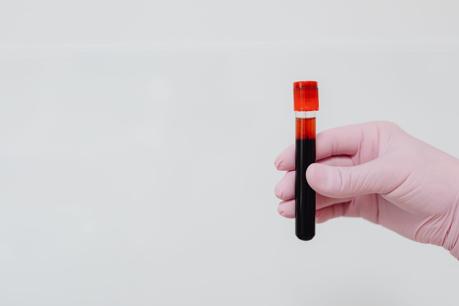 O que é bilirrubina direta no exame de sangue