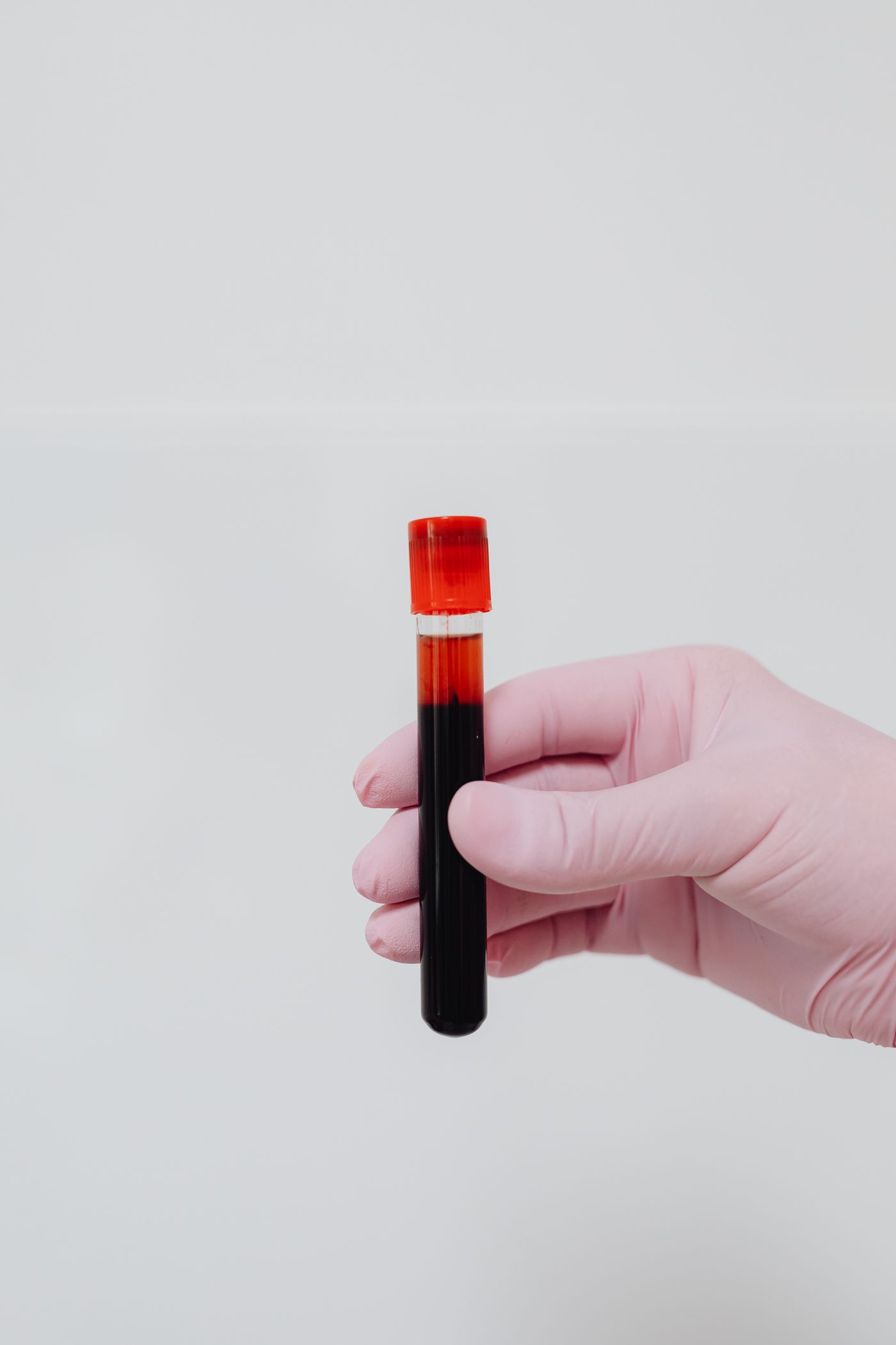 Separated platelet rich plasma ready for hair restoration treatment