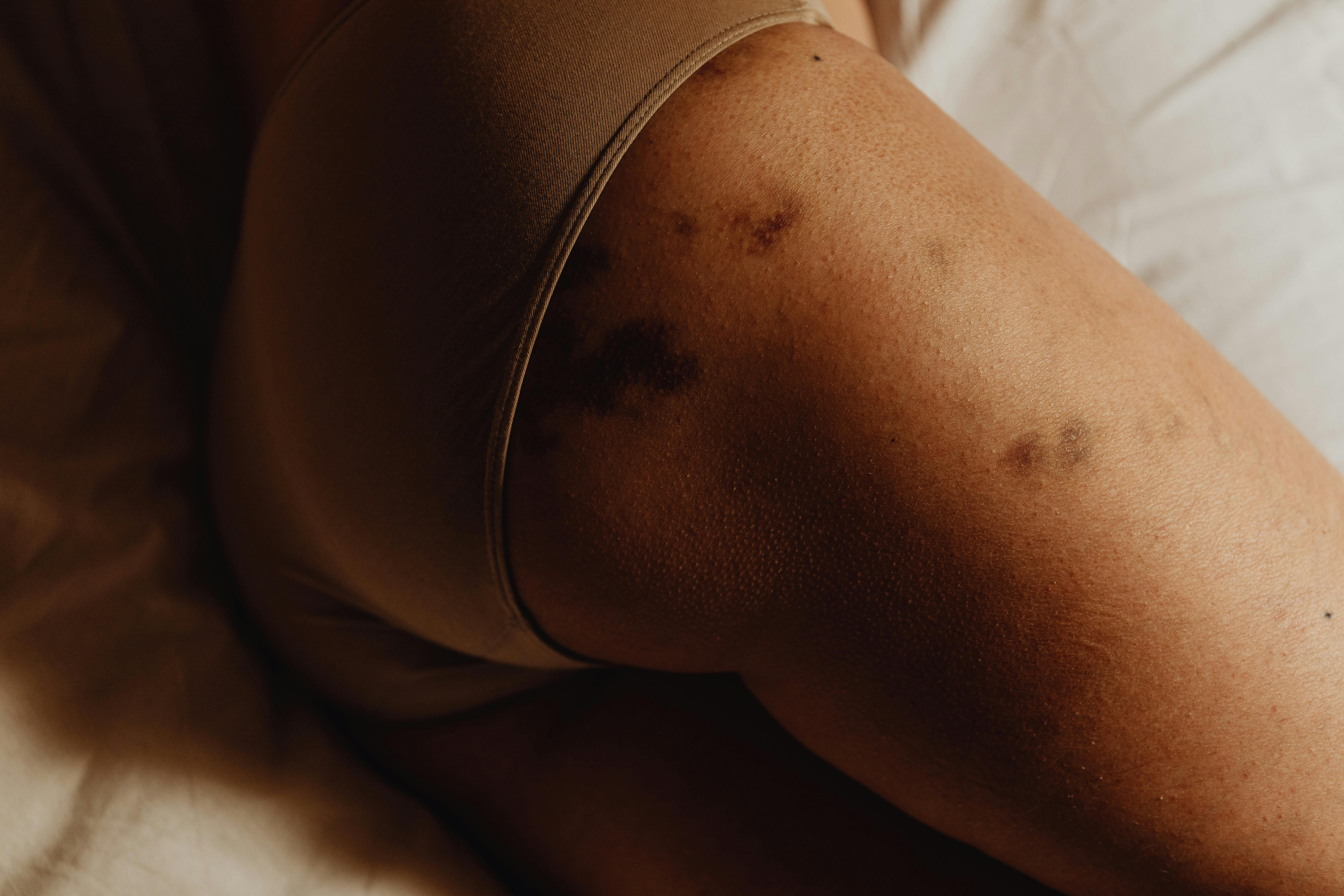 close up of woman buttocks in bruises