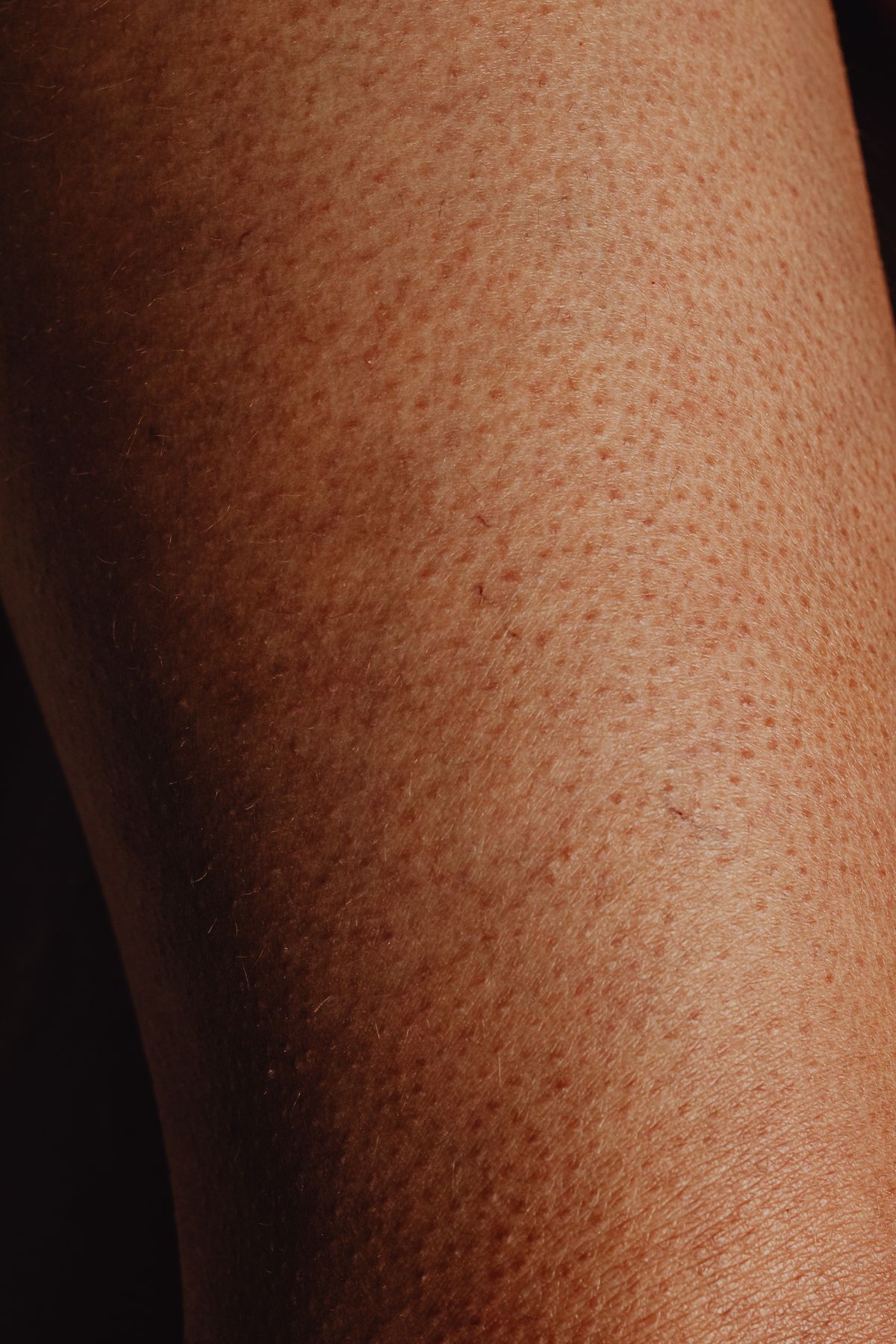 Reibeisenhaut aus der Nähe: kleine raue Knötchen rund um die Haarfollikel an Arm und Bein