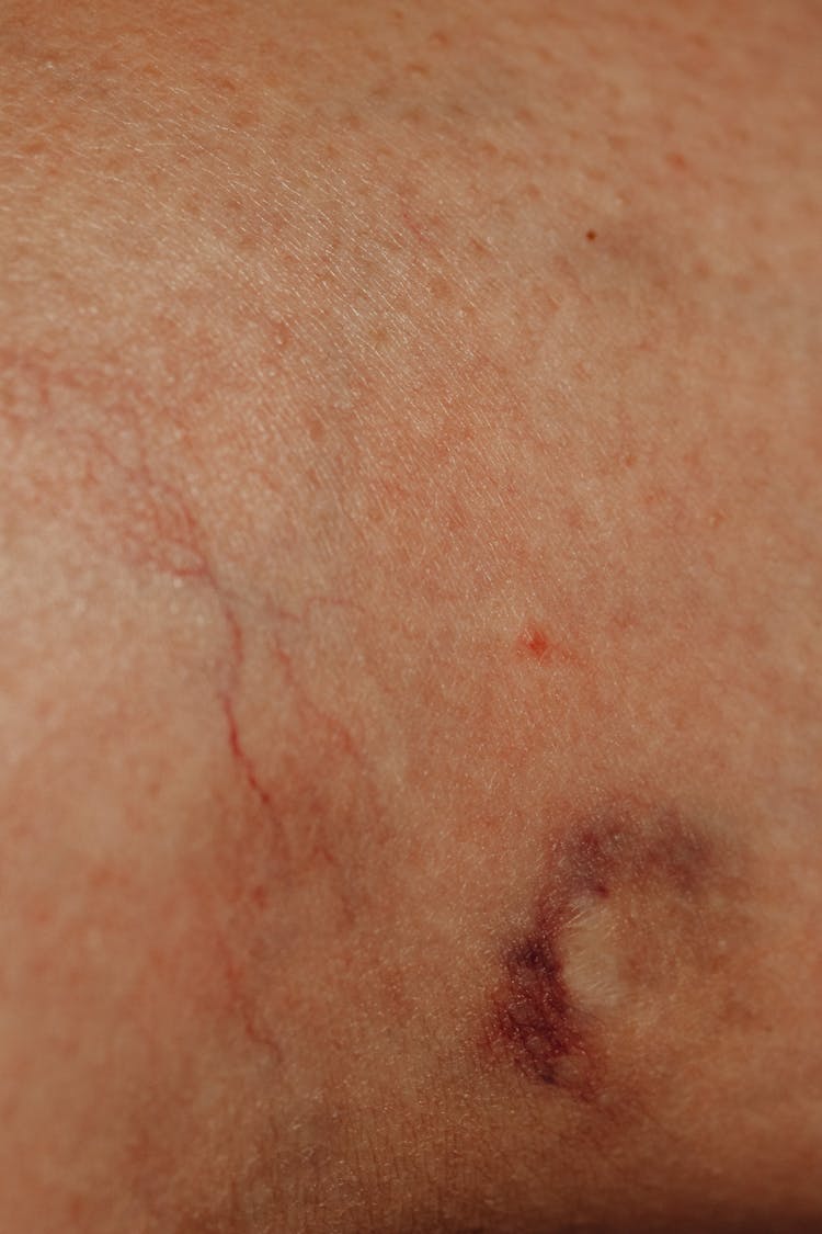 Close Up Of A Mark On Skin