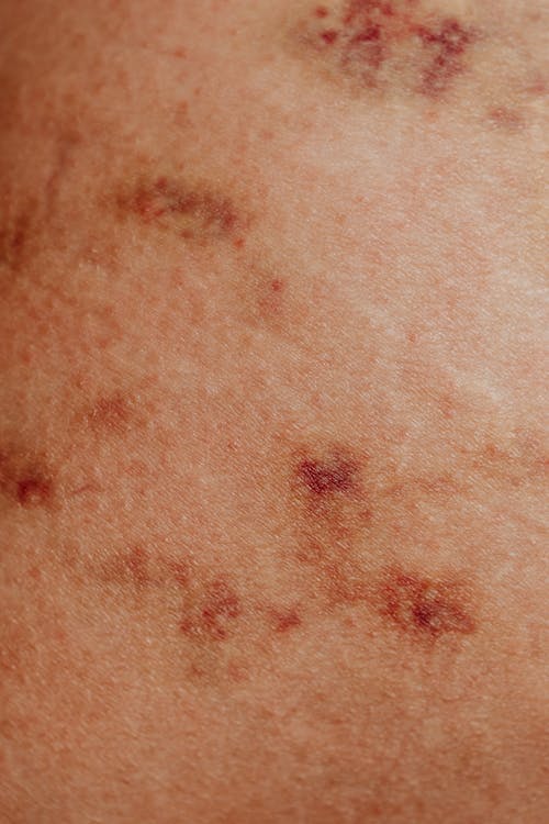 Základová fotografie zdarma na téma červená, dermatologie, kožní porucha