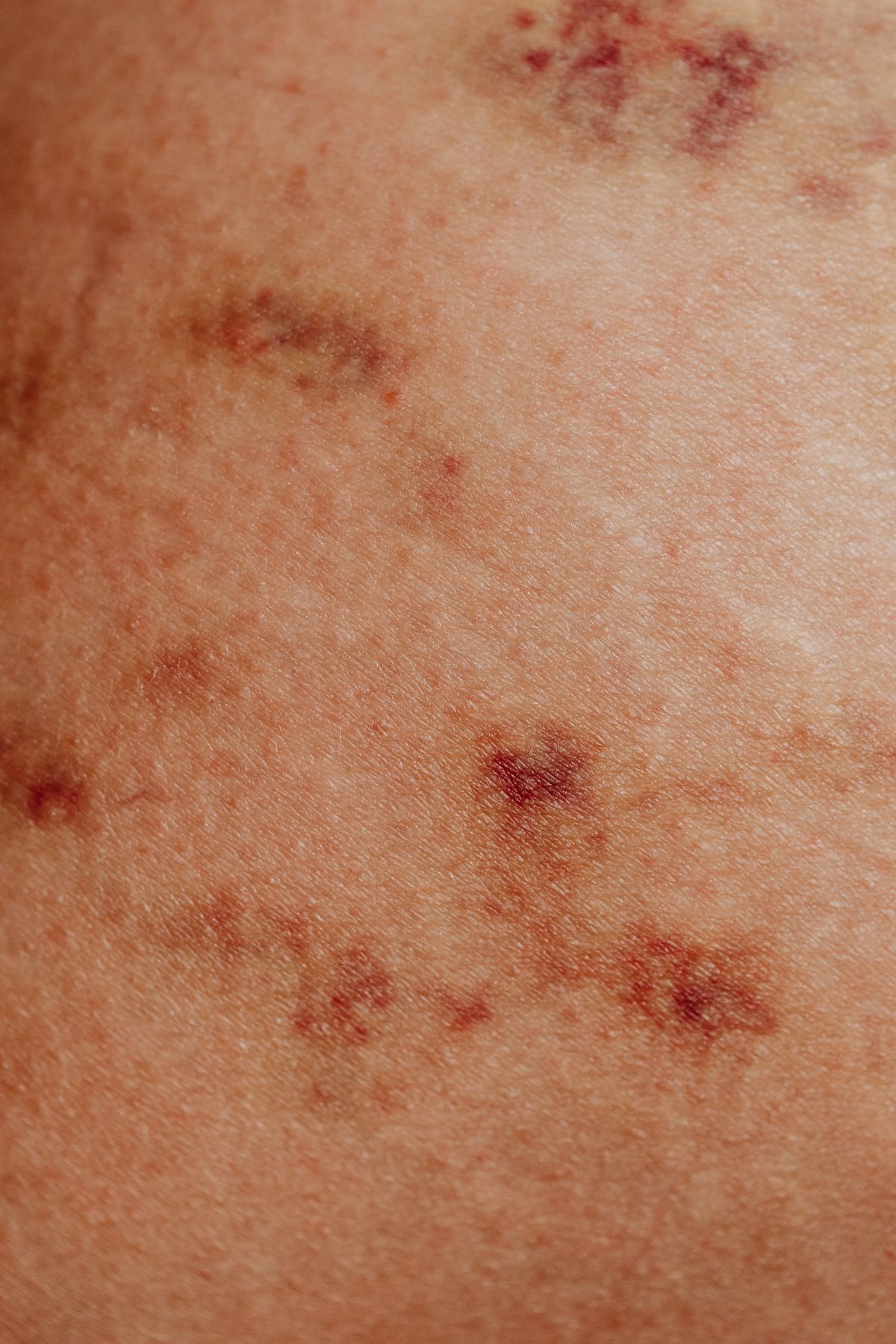Skin Tags, Benign Lesions & Warts overview