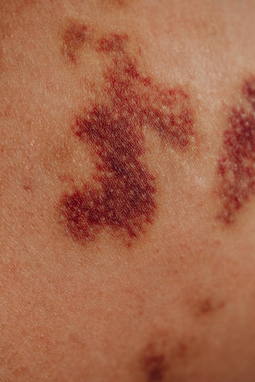 Close-up of Bruises on Body