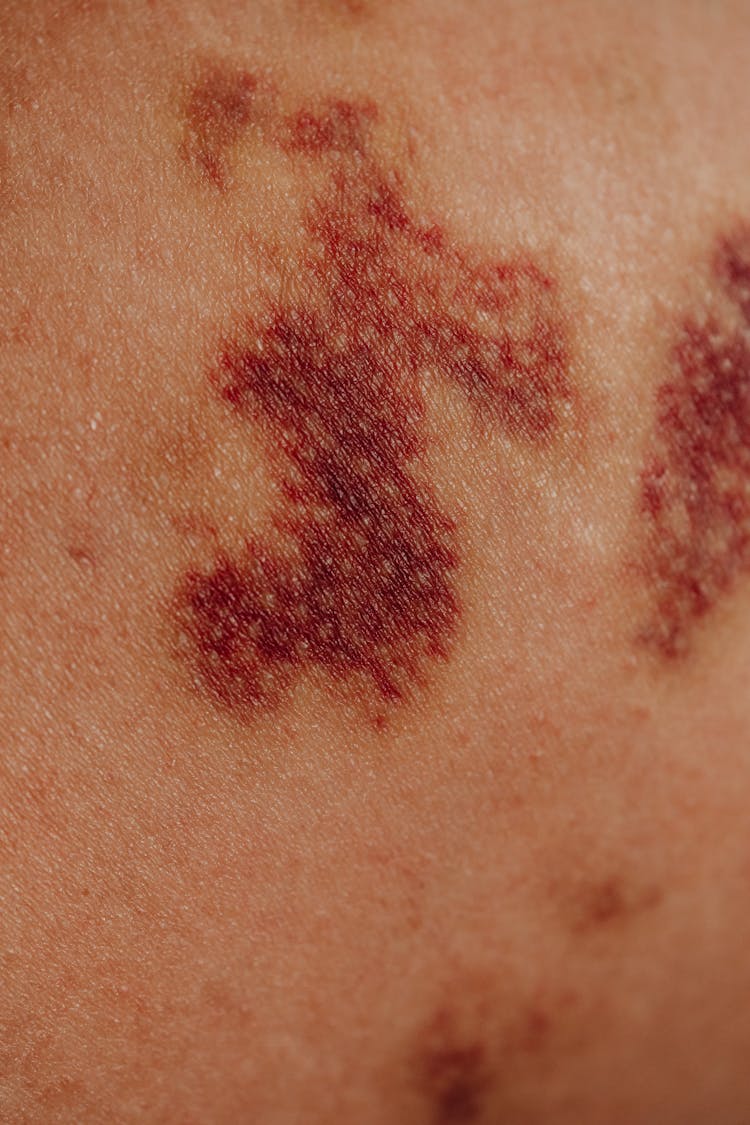 Close-up Of Bruises On Body