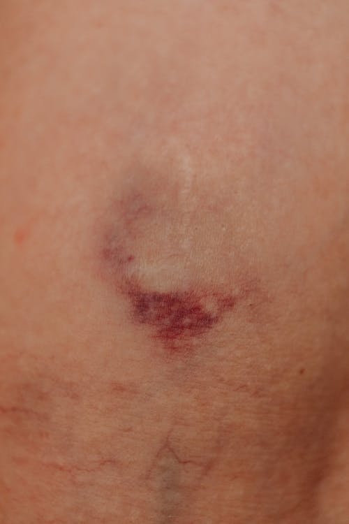 Close up of a Bruise
