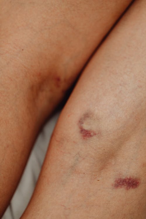 Close-up of Person Skin with Bruises