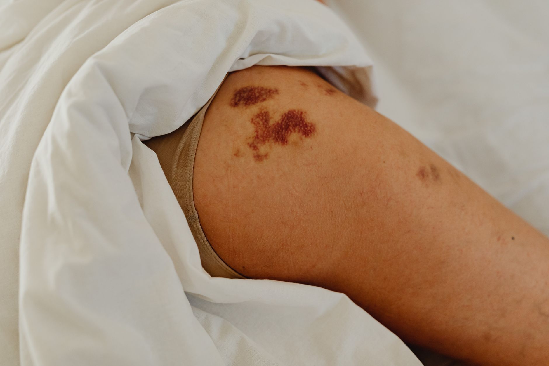 Understanding Purpuric Rash: Causes, Symptoms, and When to Seek Help