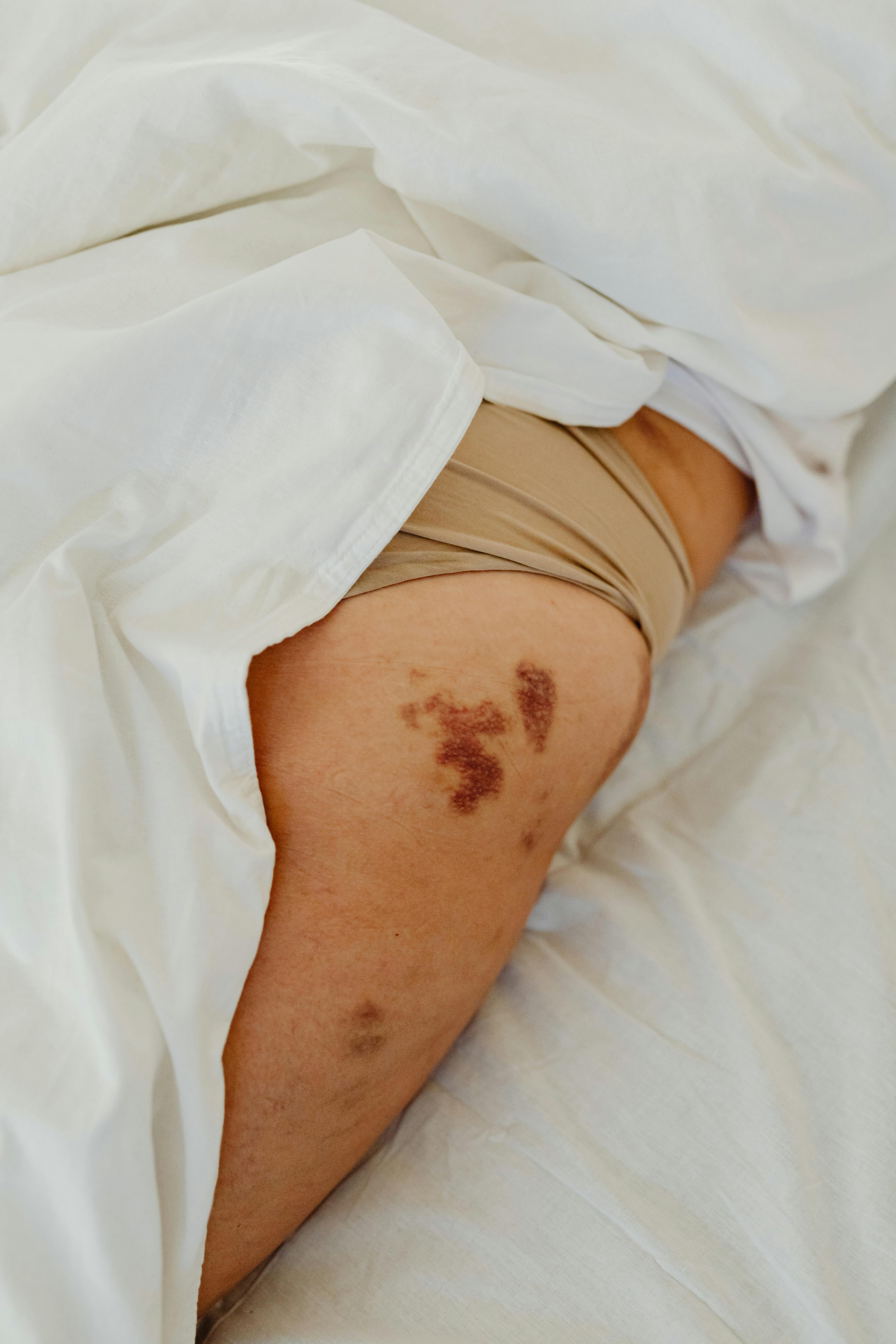A close-up shot of a bruised leg lying in bed covered partially with white sheets.