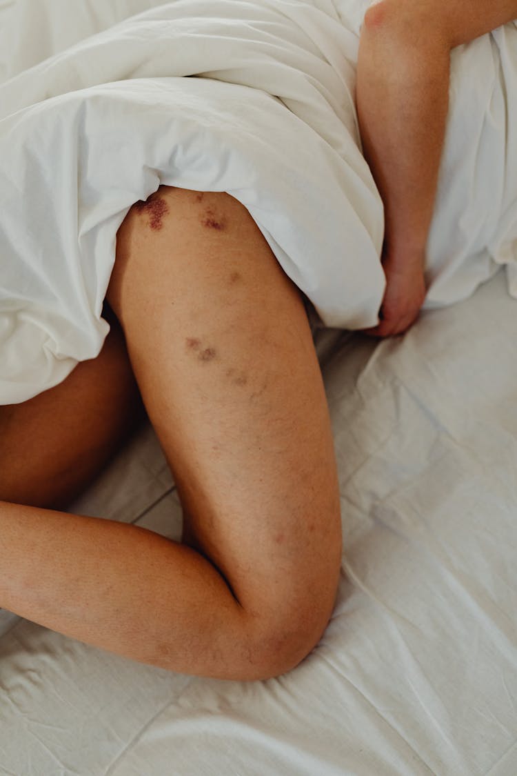 A Person In Bed With Marks On Their Leg