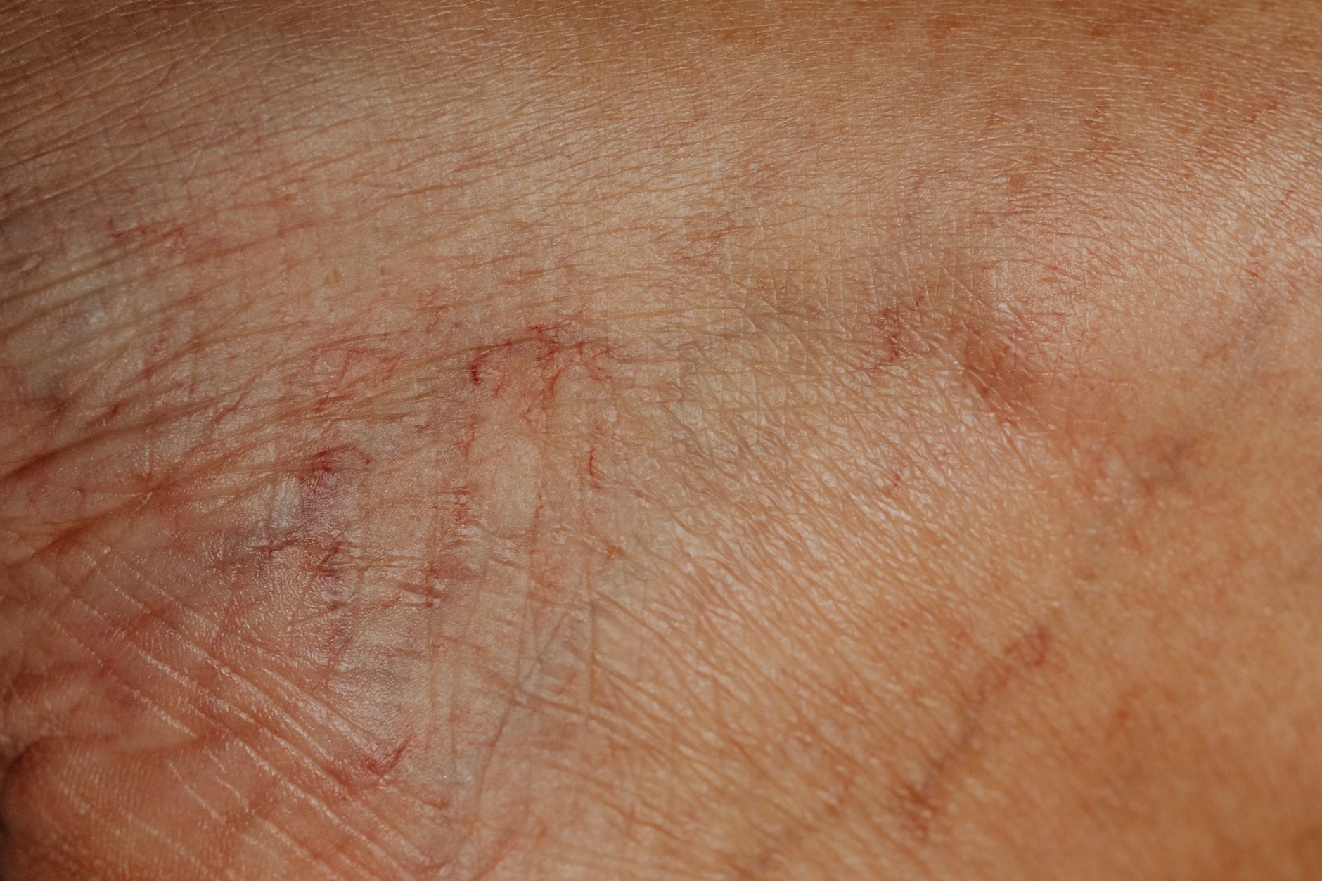 Why Do My Veins Look Green? Understanding Vein Appearance