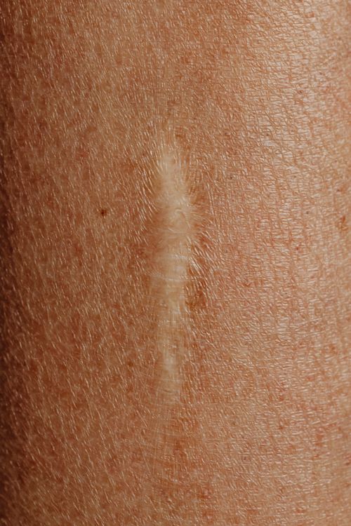 Free Close up of a Scar Stock Photo