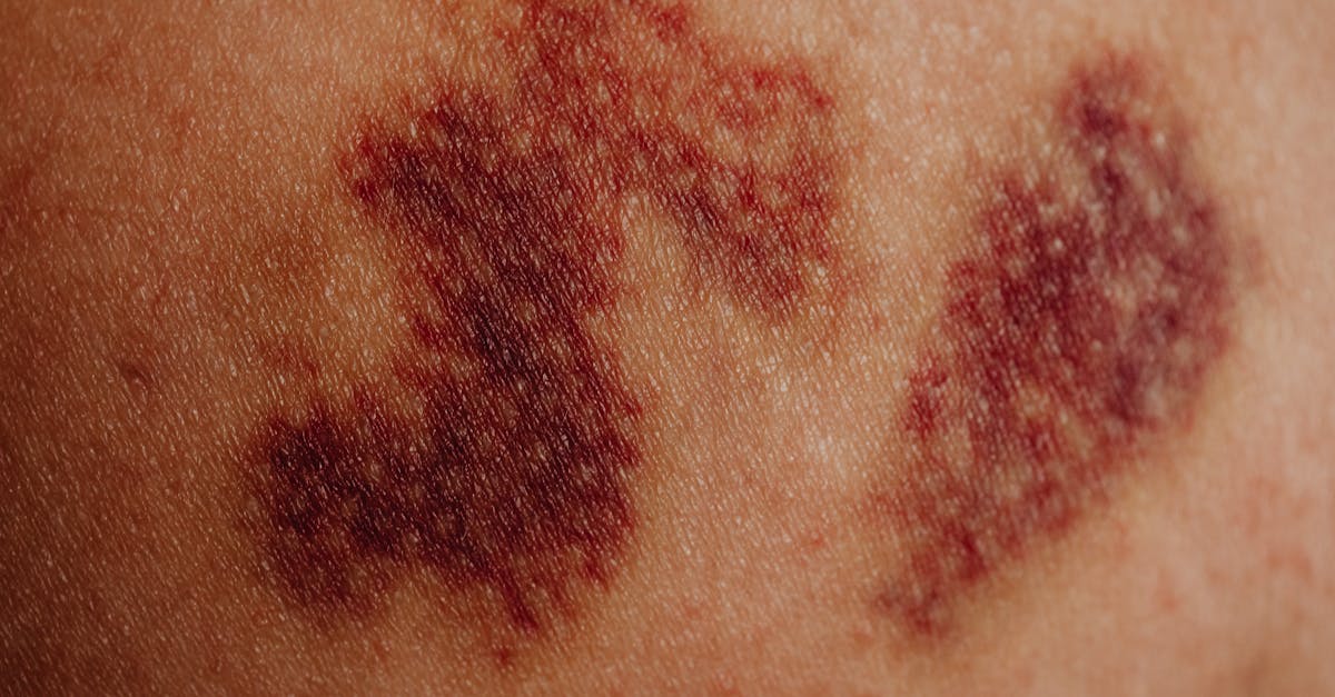 Unexplained Bruising On Older Skin, Showing Large Purple Marks On Arms Or Legs