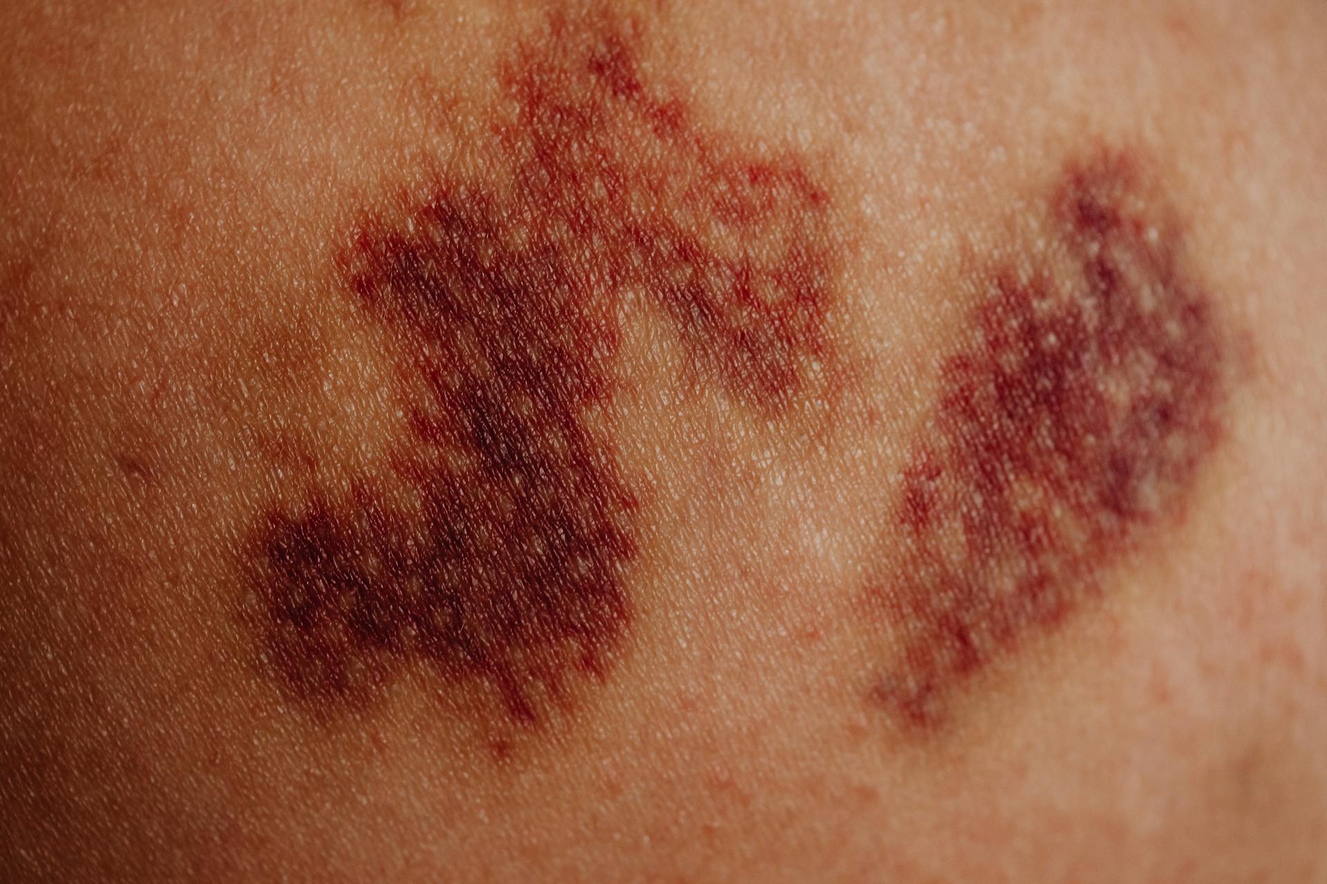 Close-up of Bruises on Body