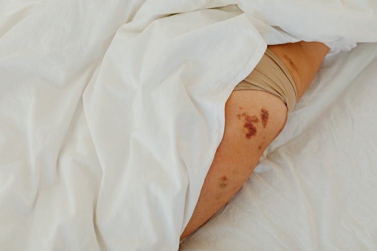 A Person With Marks On Their Leg Lying Down In Bed