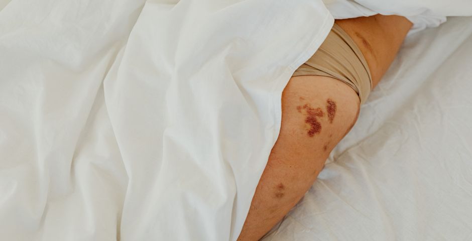 Marks on a person's skin while lying in bed — bed bug bites typically appear on skin exposed during sleep