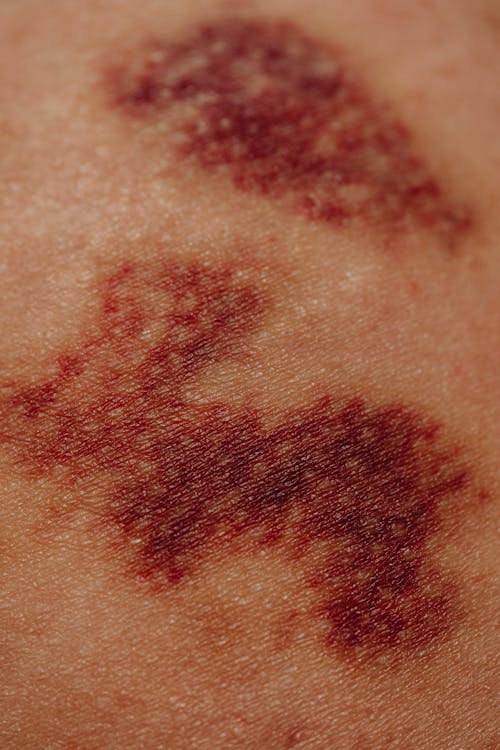 Close-up of Bruises on Human Body