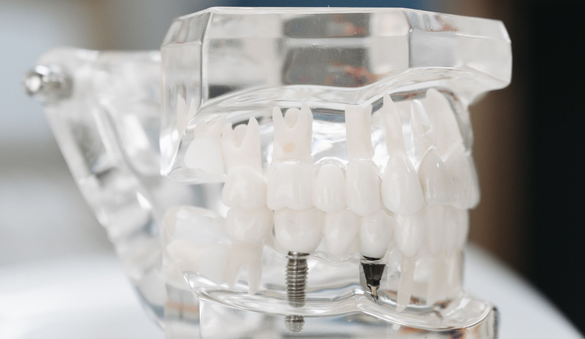 Dental Implants