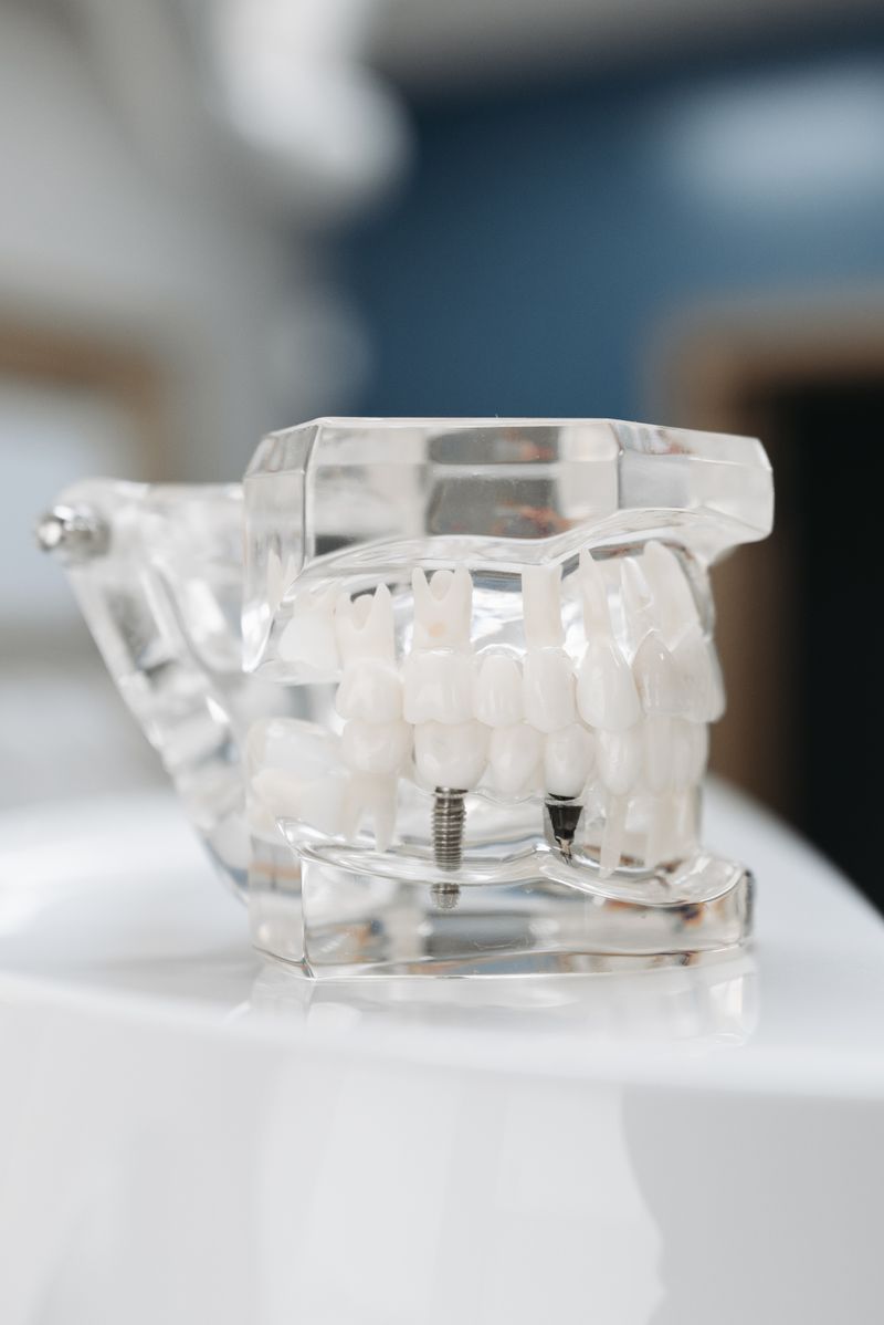 Modèle transparent d'une armature implanto-portée