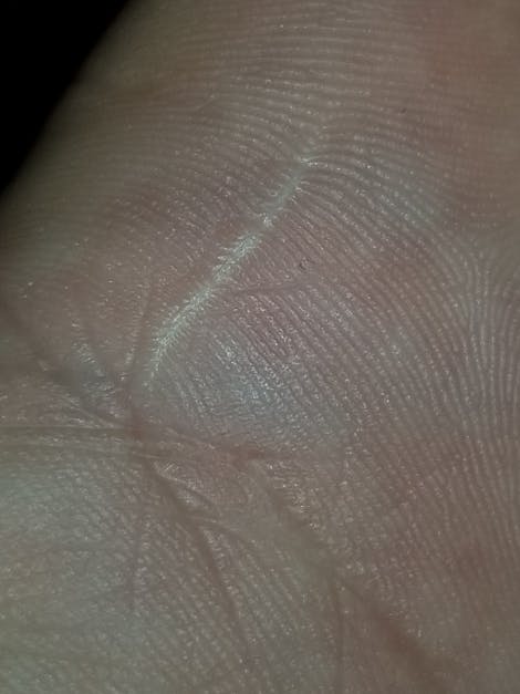 Free stock photo of hand scar, scar, scars