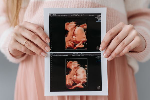 Step 4: Ultrasound-guided amniotic fluid collection from pregnant woman